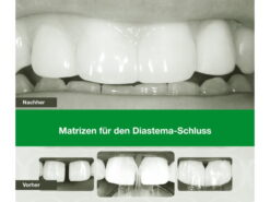 Matrizen für den Diastema-Schluss
