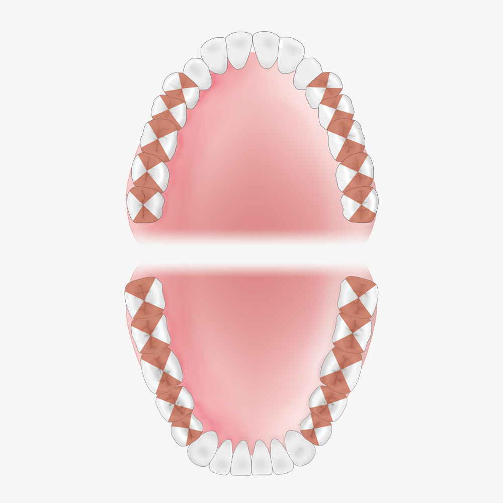 Double Gracey Mini Posterior, XP2, gold - Griff Rot, posterior – Image 2