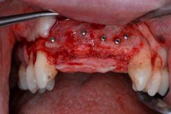 Alternative view of stoma® micro-screw Set