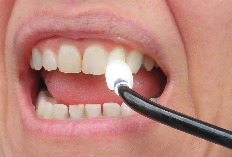 VAC-TAK Veneer Placement - Image 4