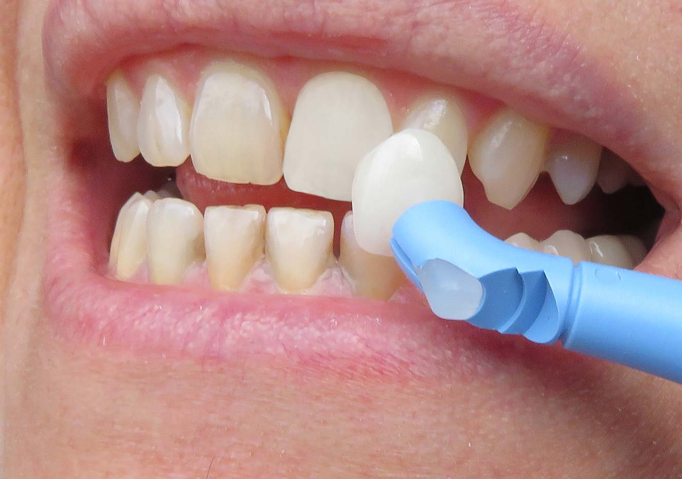 VAC-TAK Veneer Placement - Image 2