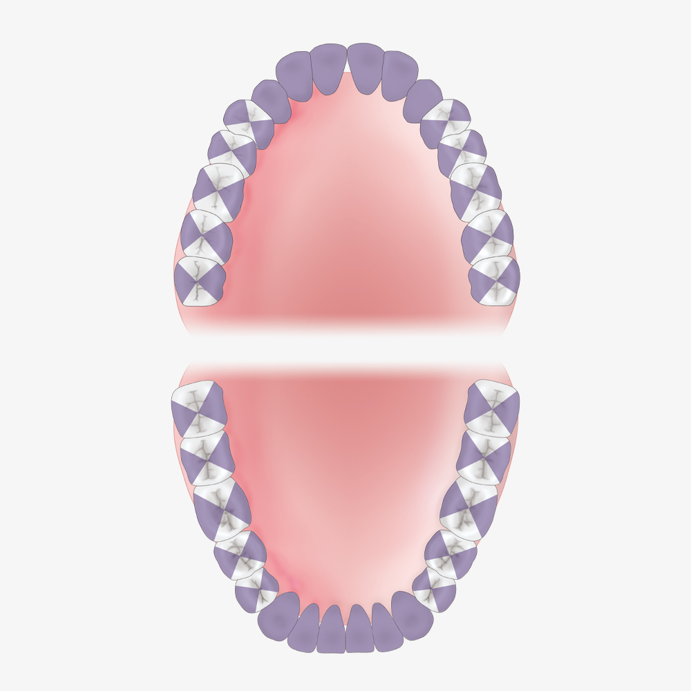 Double Gracey Anterior, XP2, gold - Griff Purple, anterior – Bild 2