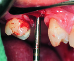 Alternative view of Osteotom, Kondenser, Iglhaut bajonett Fig. 2