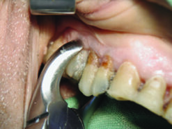 Alternative view of Davier molaires supérieures, droite, fig. 17, Fifo - 50% Aktion