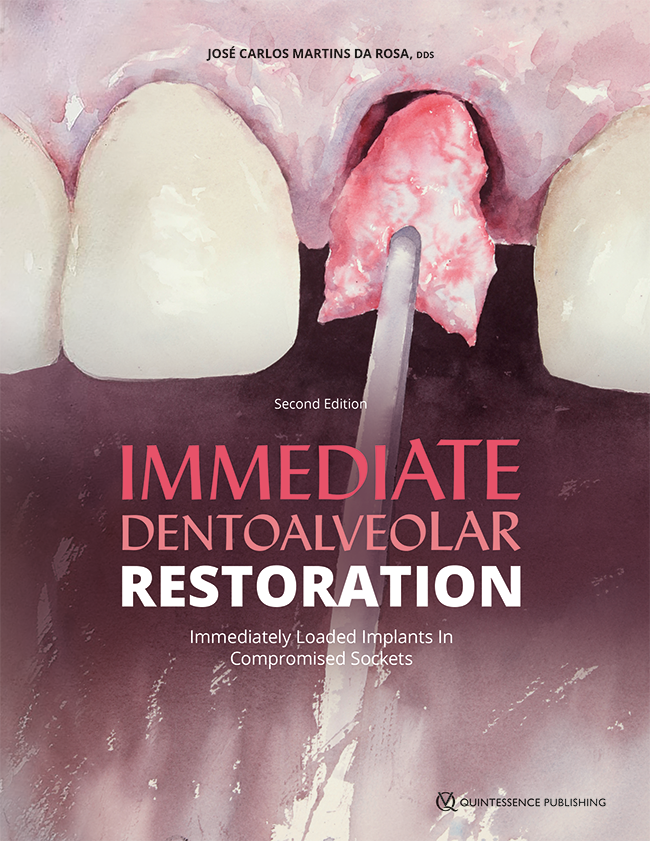Immediate Dentoavleolar Restoration